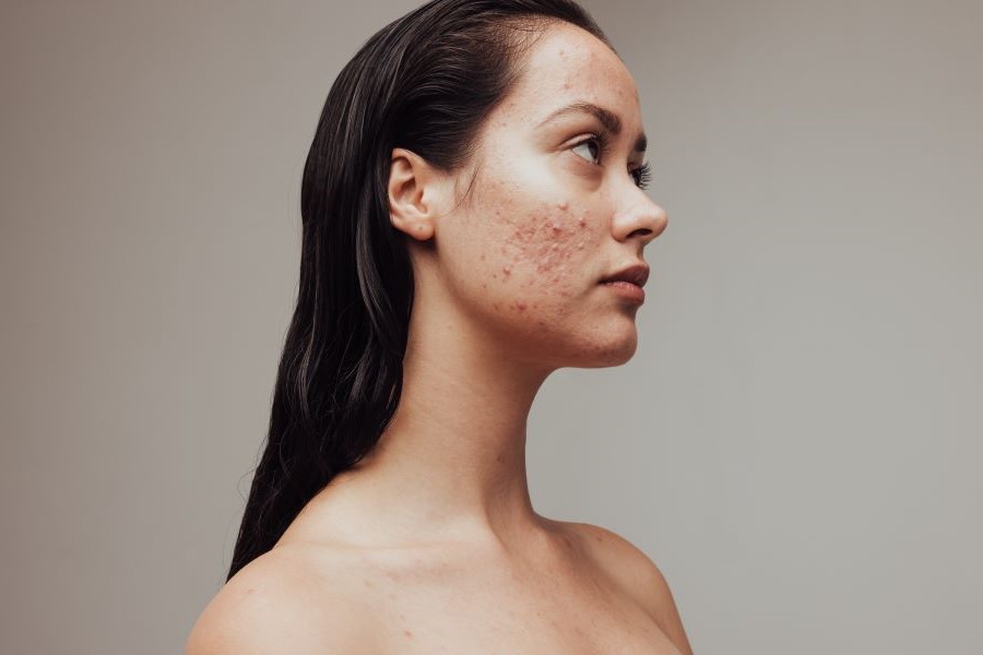 Acne prone skin